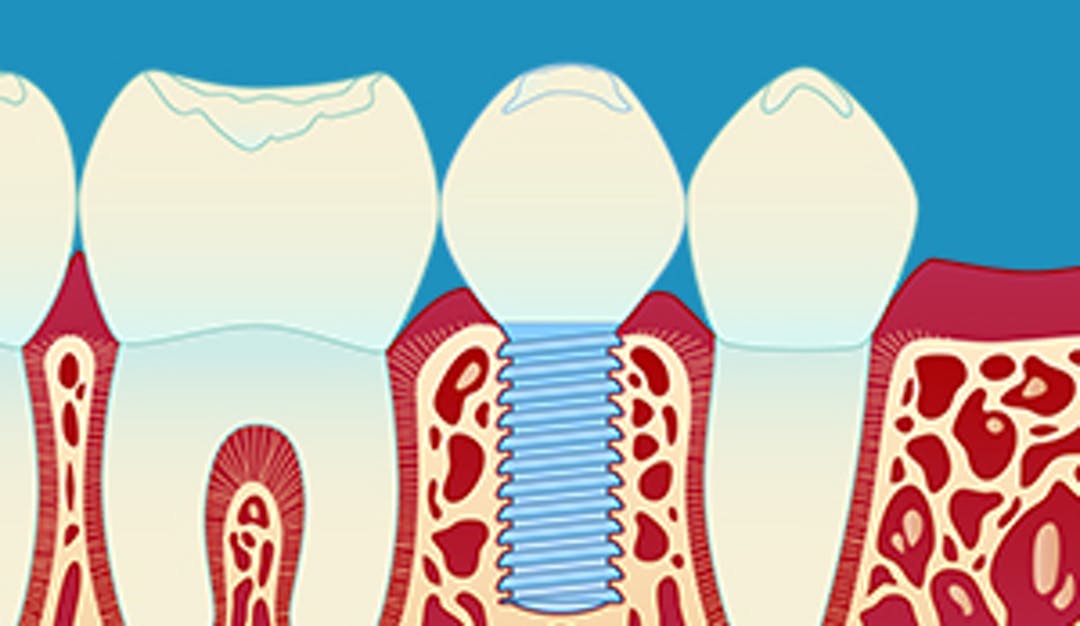Implantat_enkel_thumbnail_w300__c119e95483413dad59589c36bf8a6e81-1
