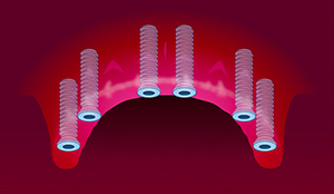 Implantat_hel_kjeve_thumbnail_w300__c0d0fbf301f3a14c1a596f24d63c9160